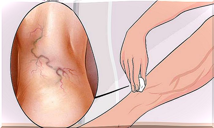 A natural treatment for varicose veins from apple wine vinegar, carrot and aloe vera.