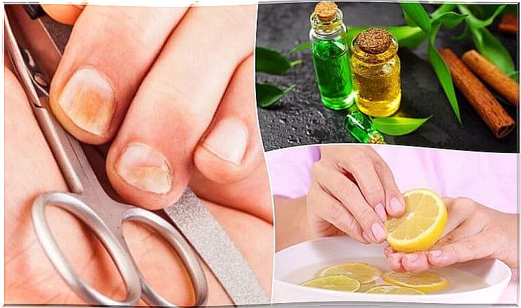 5 Ways To Bounce A Nail Fungus And Strengthen Your Nails