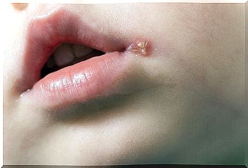 treatments for cold sores in children