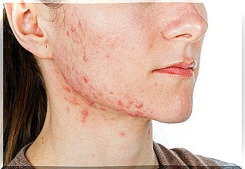 Acne can be a sign of nutrient deficiencies