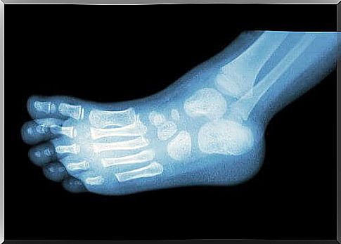 heel spike pathogens and treatment x-rays