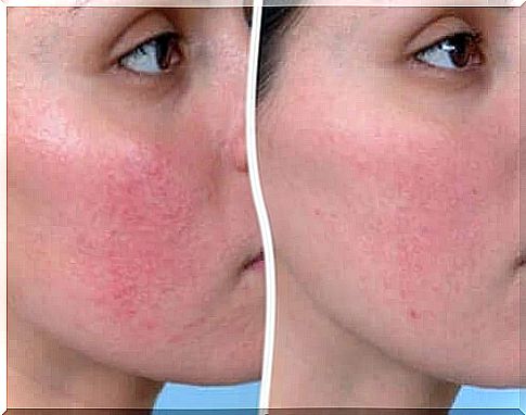 Couperosa causes redness on the skin