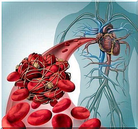 deep vein thrombosis