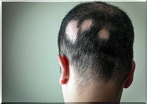 Alopecia areata is a very little known pathology