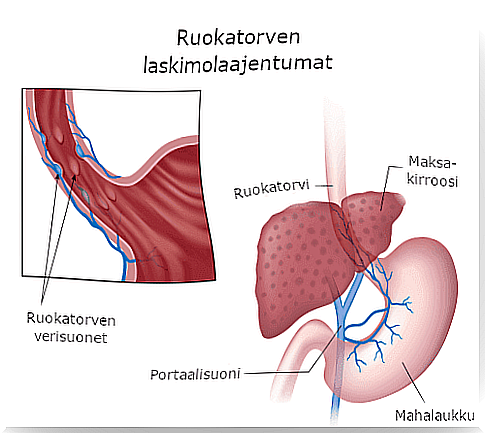 Esophageal varices