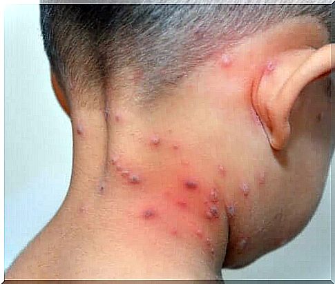 Herpes zoster in a child.