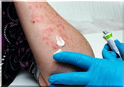 Treatment of herpes zoster.