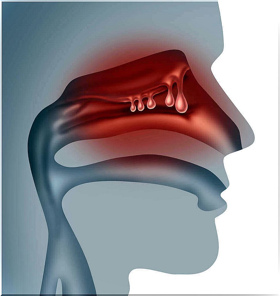 How to treat nasal polyps naturally