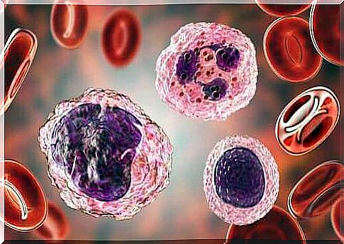 Large number of monocytes in the blood: what are its symptoms and how is it treated?