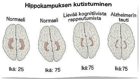 Learn to recognize the early signs of Alzheimer's