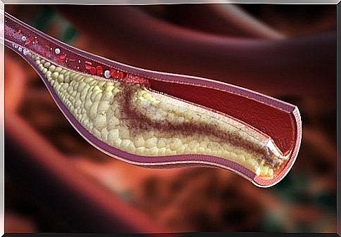 In atherosclerosis, the arteries harden