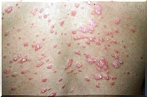 Psoriasis - what is it and what are the different forms of the disease?