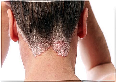 Psoriasis of the neck