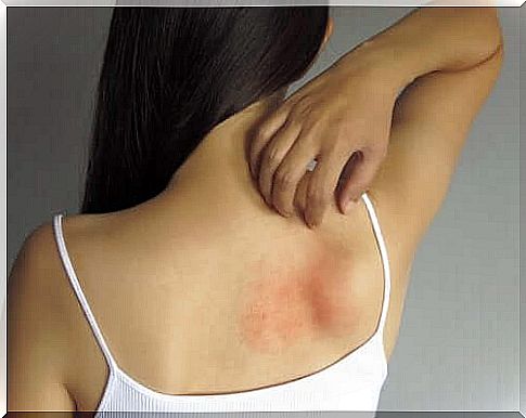 Rash alleviation with 5 topical treatments