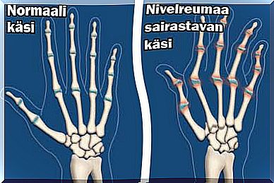 arthritis and rheumatoid arthritis