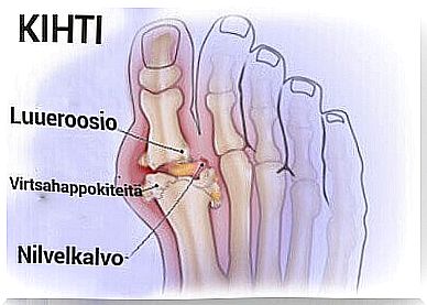 arthritis and gout