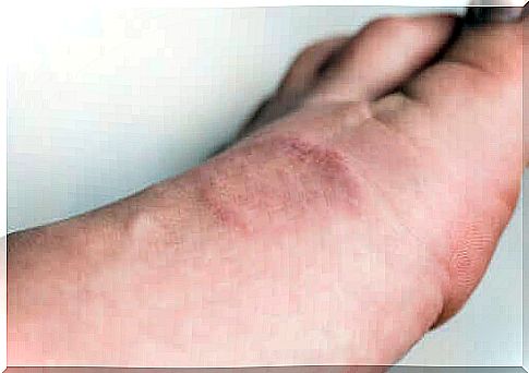 Ring granuloma: symptoms and treatment