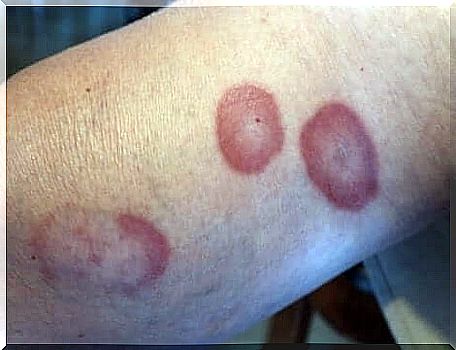 Ring granuloma causes annular nodules on the skin.