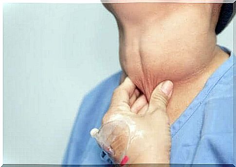 A painless nodule in the neck is a symptom of thyroid cancer