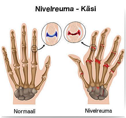 Too little water intake can predispose to rheumatism.