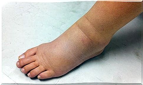 Treatment of swollen ankles and feet